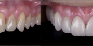 DMAX氧化锆贴面，为牙齿带来完美转变